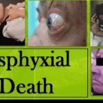 Asphyxial Death